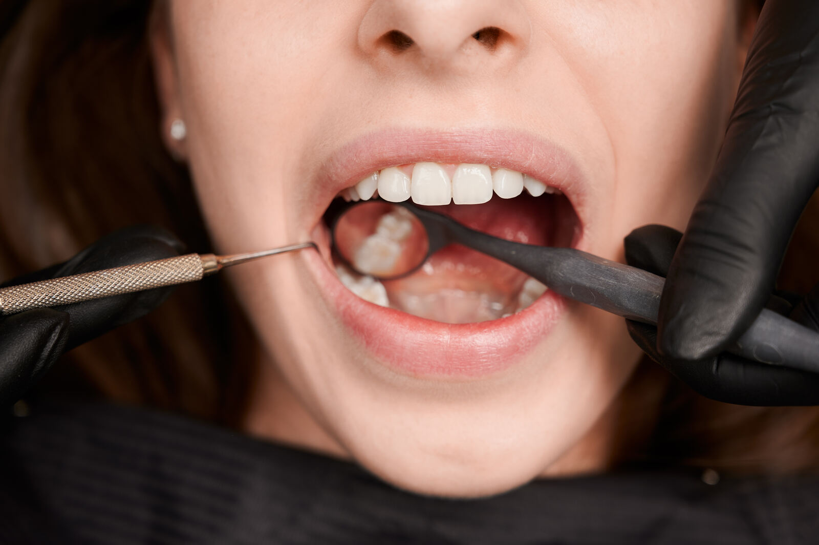 Tratamento de canal odontológico