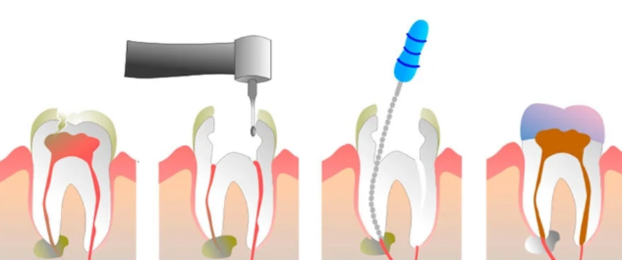Passo a passo do tratamento de canal odontológico
